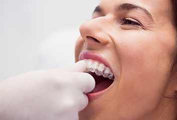 white diamond clear aligners