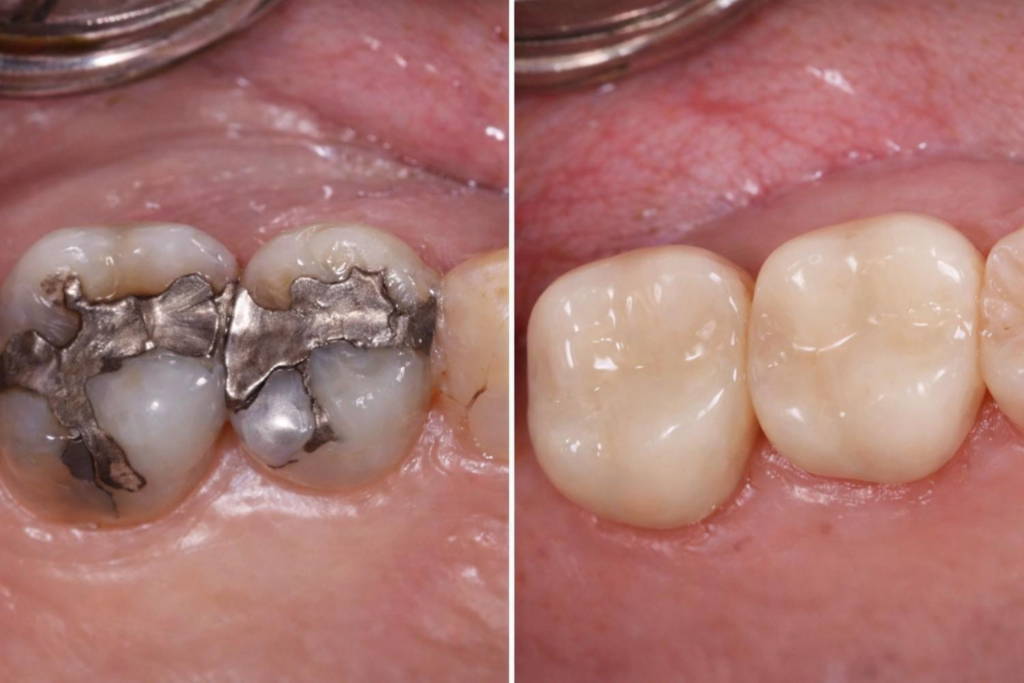 Before and after dental crown treatment replacing damaged metal fillings with natural looking ceramic crowns