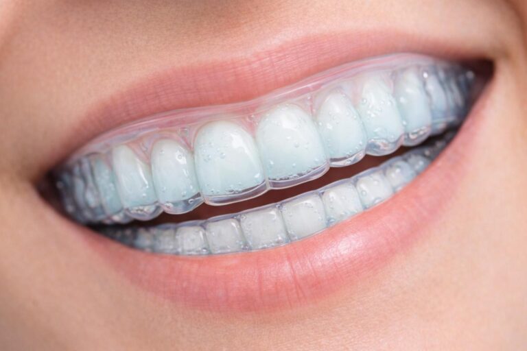 Close up of clear Perio Protect trays on teeth used for non surgical gum disease treatment.