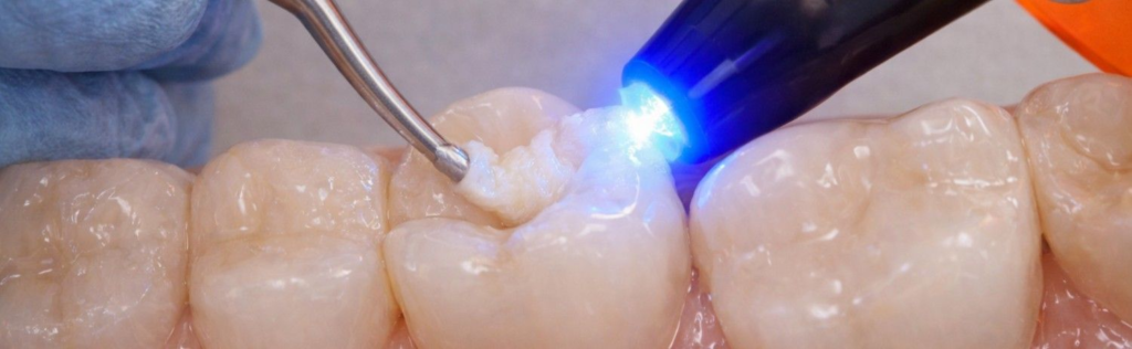 Dentist placing a mercury free composite filling on a tooth using a curing light during a dental restoration procedure in Colorado Springs.