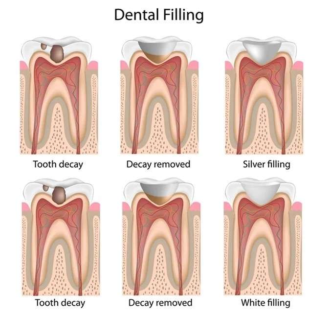 Step by step dental filling procedure showing tooth decay removal and silver and white filling placement